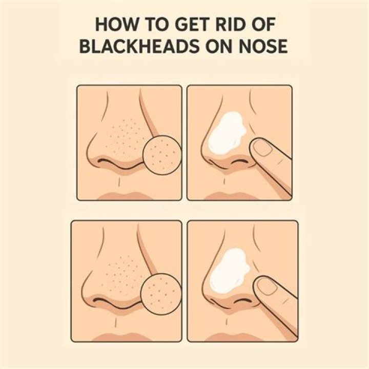 How do you get rid of blackheads on your nose with baking soda?