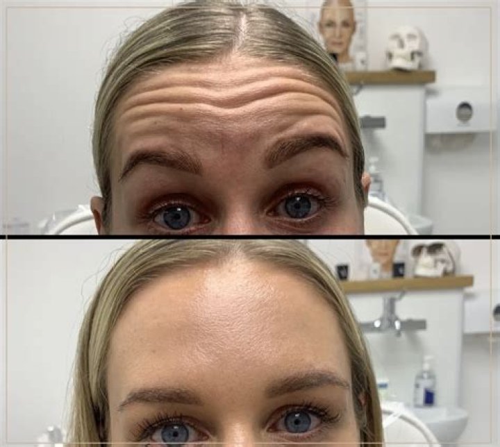 How do you get rid of wrinkles without Botox or surgery?