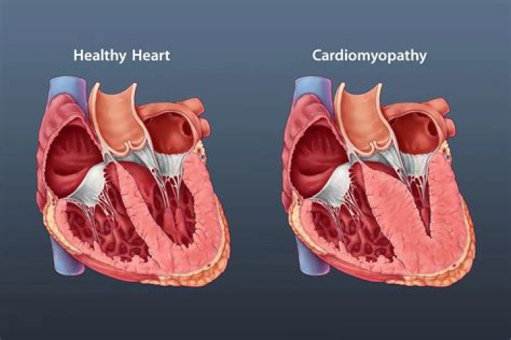 How long can you live with cardiomyopathy?
