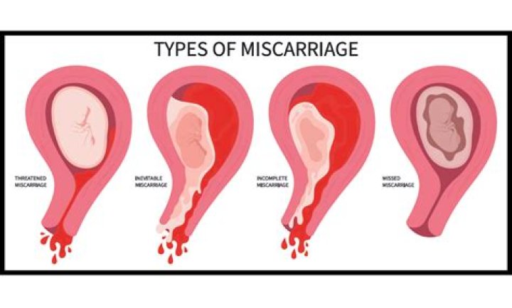 How long does a miscarriage take?