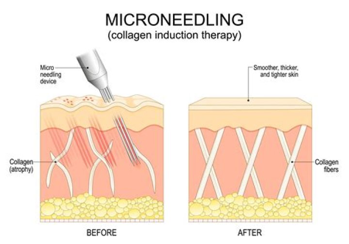 How long does microneedling last for wrinkles?