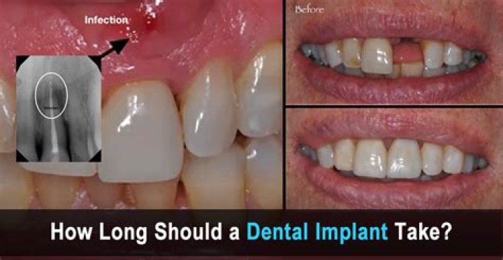 How many implants can you have at once?