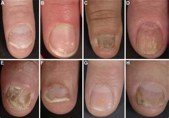 How nail psoriasis is look like?