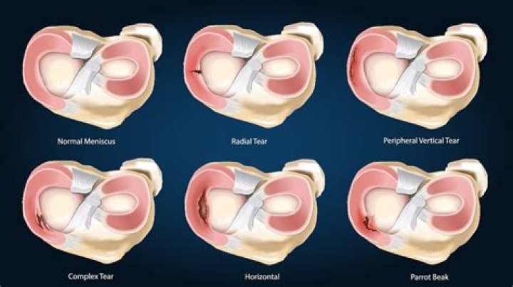 How painful is a torn meniscus?