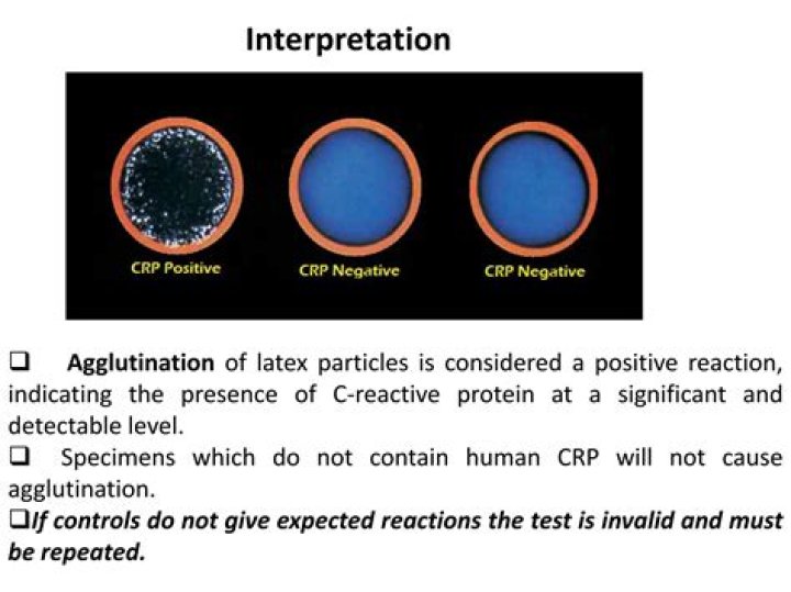 In which condition is CRP positive?