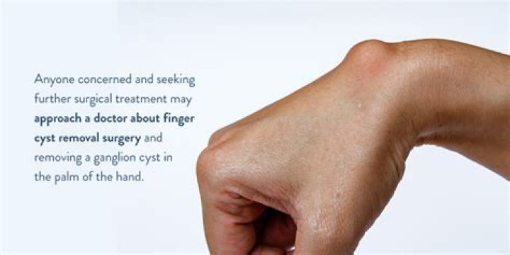 Is it painful to have a cyst removed?
