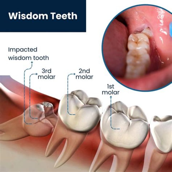 Is laughing gas used for wisdom teeth?