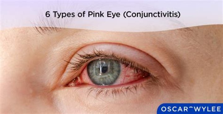 Is pink eye caused by stress?