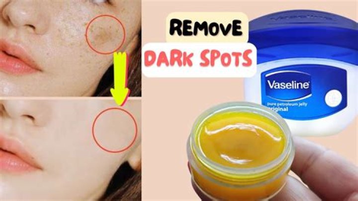 Is Vaseline good for spots on face?