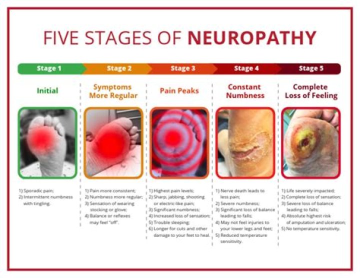 What are the five stages of neuropathy?