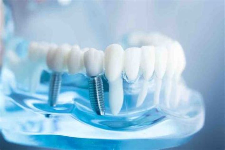 What are the negative effects of dental implants?