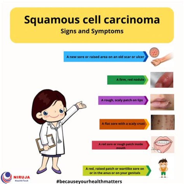 What are the warning signs of squamous cell carcinoma?