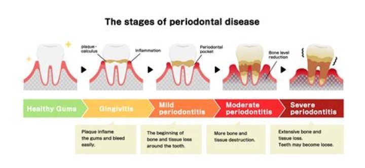 What can a periodontist do for bone loss?