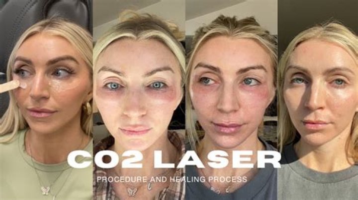 What can go wrong with CO2 laser?