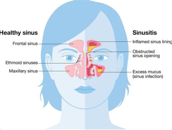 What can make a sinus infection worse?