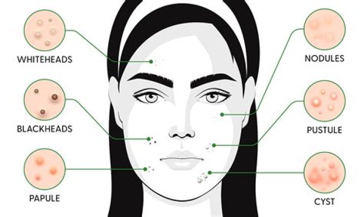 What causes big pimples on the face?