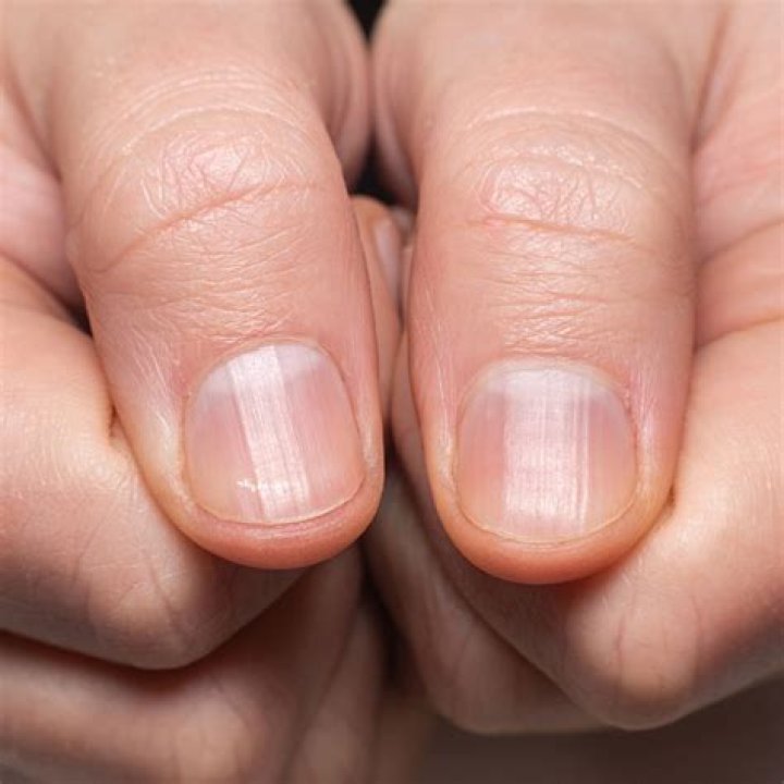 What do diabetic fingernails look like?