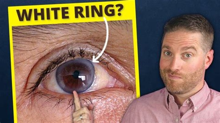 What does a black ring around your eye mean?