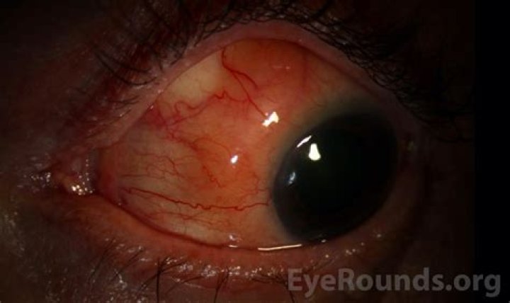 What does chemosis look like?
