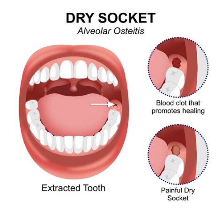 What does dry socket feel like at first?