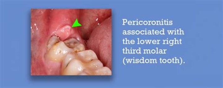 What does pericoronitis look like?
