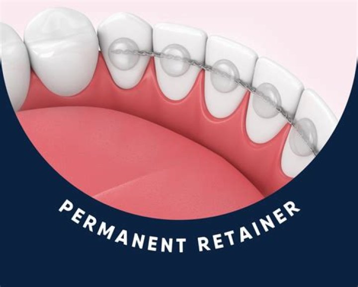 What happens if you don't wear your retainer after braces?