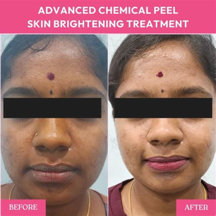 What if skin doesnt peel after microneedling?