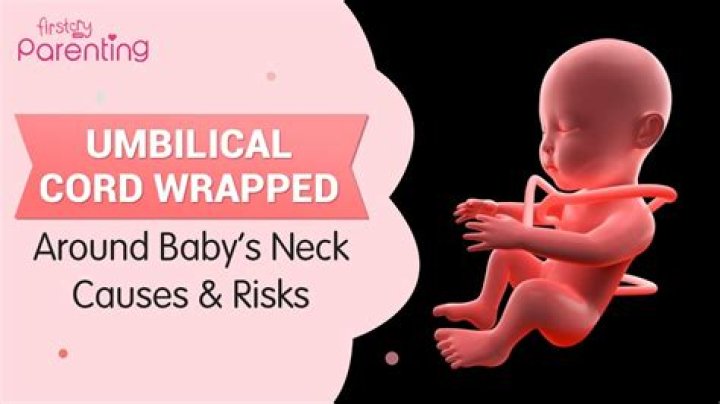What if the umbilical cord is wrapped around my baby's neck?
