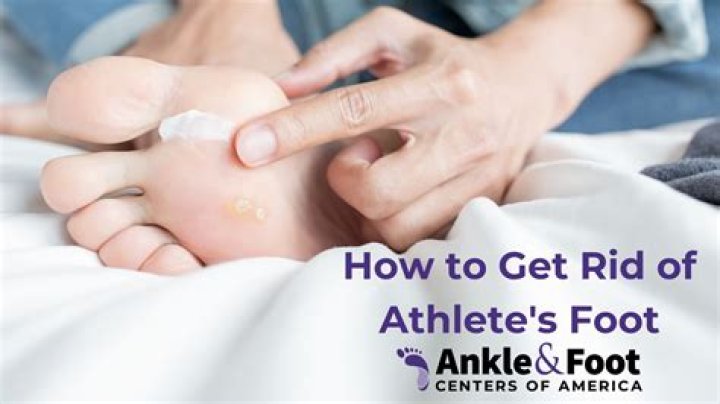 What is the best medication for athlete's foot?