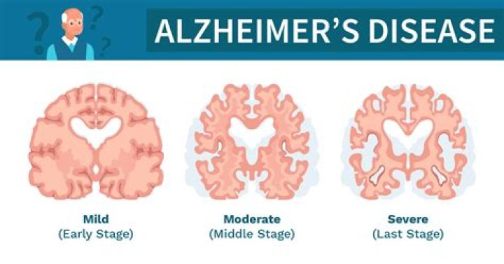 What is the first stage of Alzheimer's?