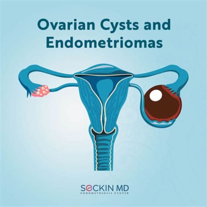 What is the main cause of ovarian cyst?