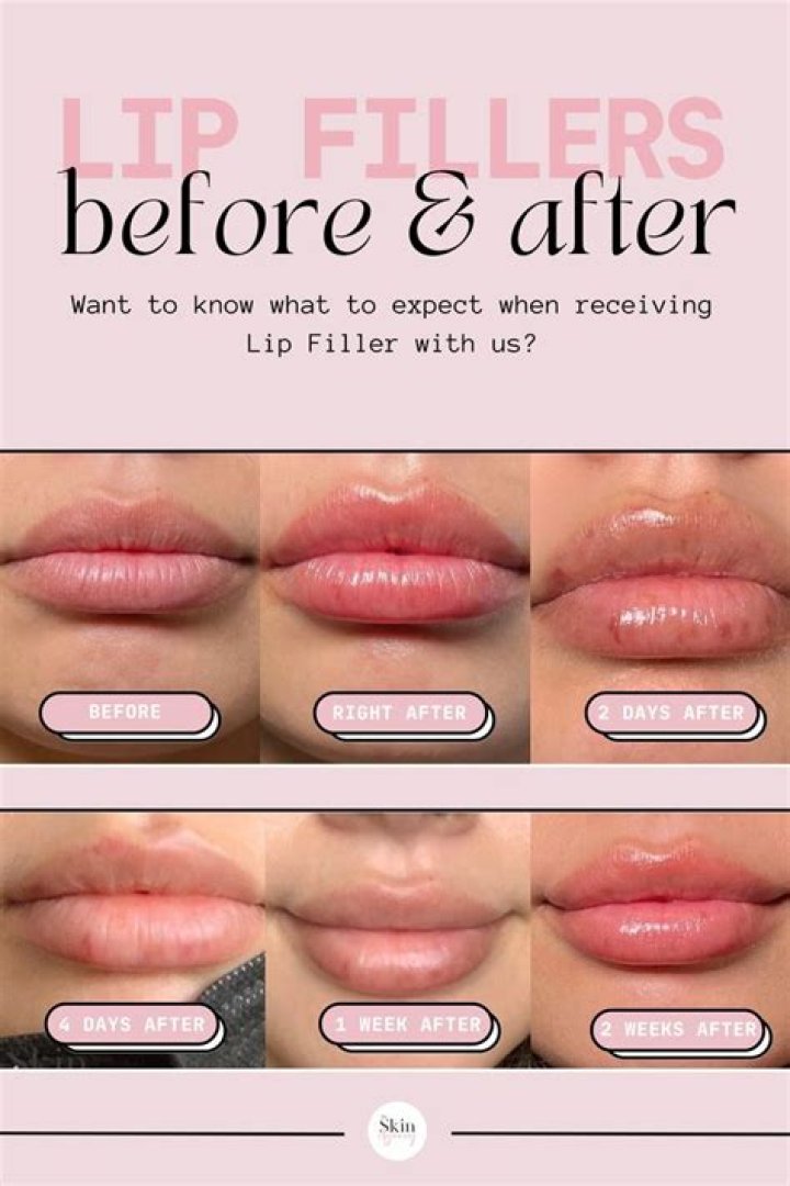 What is the perfect lip?