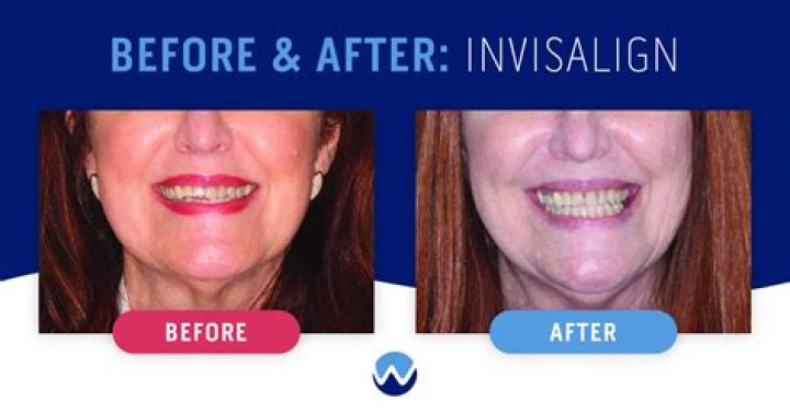 What is the second phase of Invisalign?