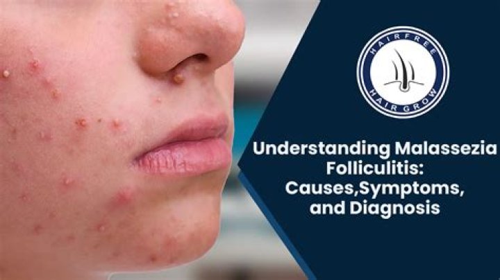 What kills Malassezia folliculitis?