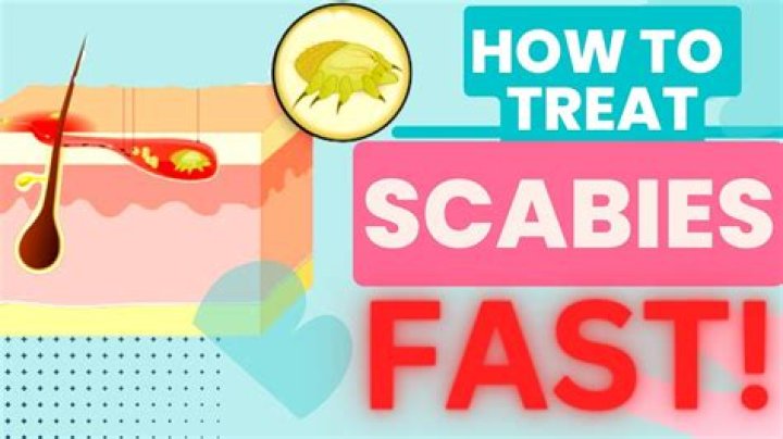 What kills scabies fast?