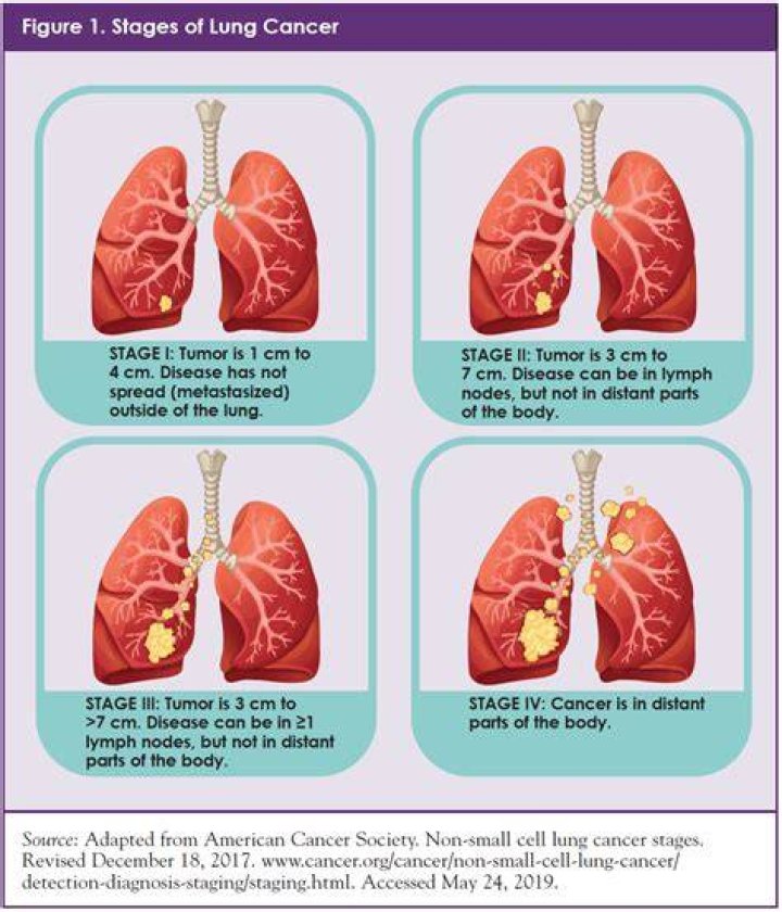What stage is a 2 cm lung tumor?