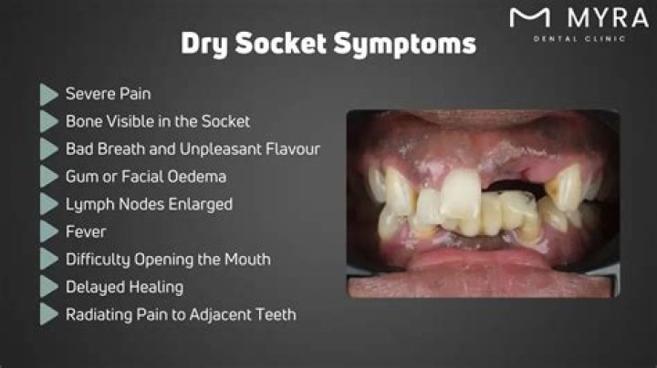 When does dry socket pain start?