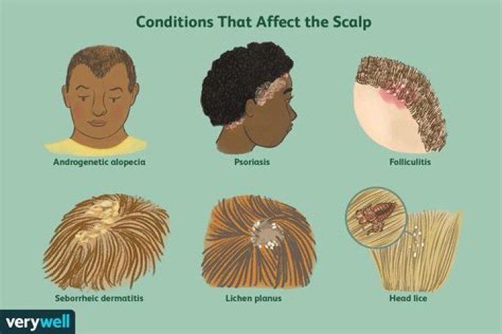 When I scratch my scalp I get yellow stuff?