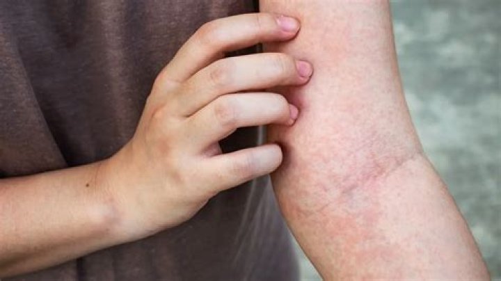 Where do you itch with kidney disease?