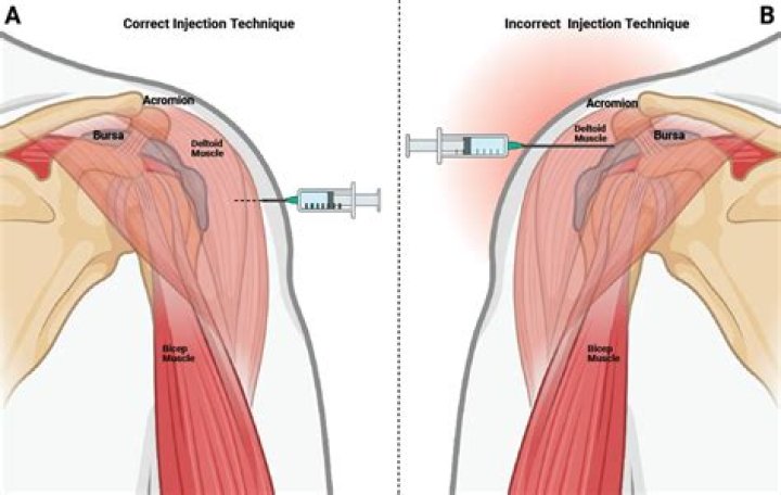 Which vein is used for injection?