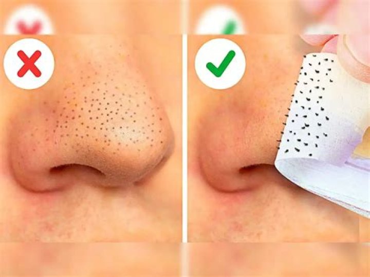 Why do 5 year olds get blackheads?