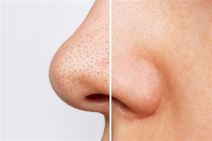 Why do blackheads fill back up?