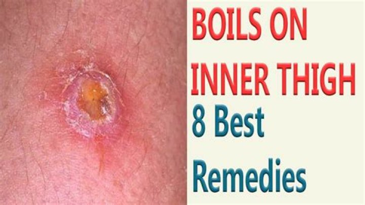 Why do I get boils between my thighs?