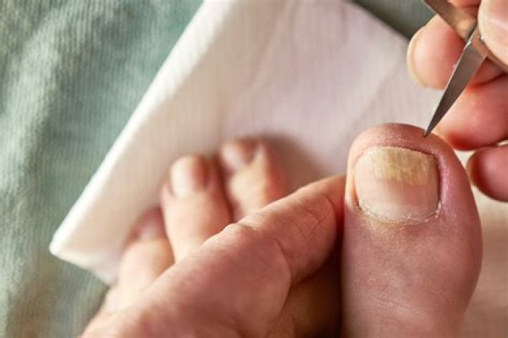 Why do I rip my toenails?