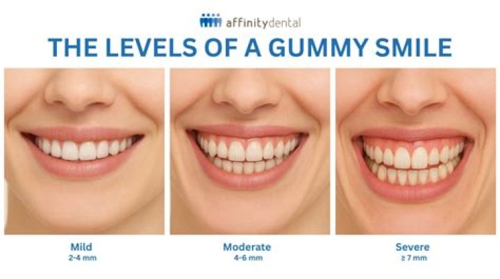 Why do some people's teeth not show when they smile?