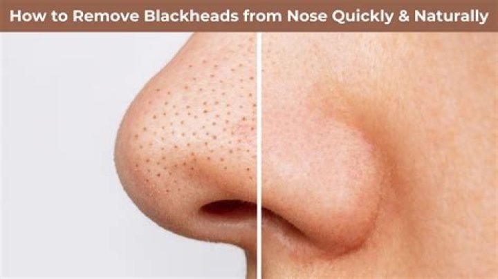 Why do we get so many blackheads on your nose?