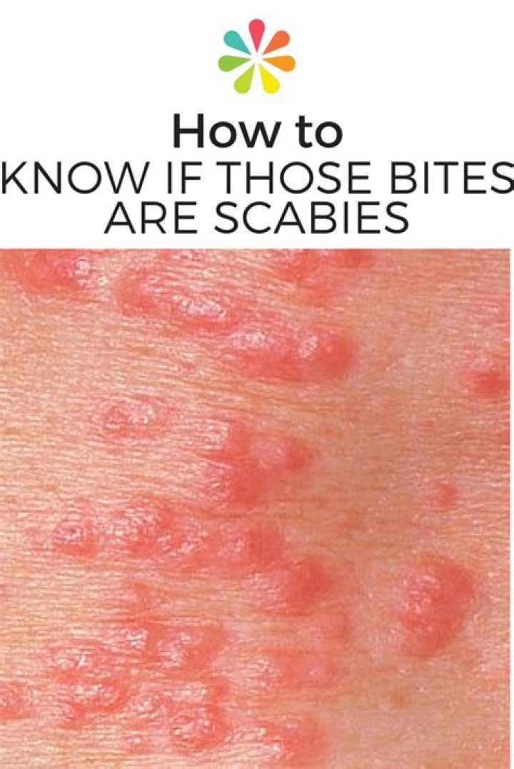 Why does scabies itch more at night?