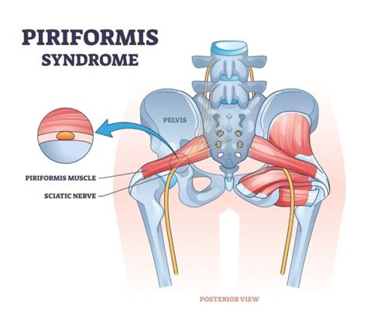 Will piriformis syndrome ever go away?